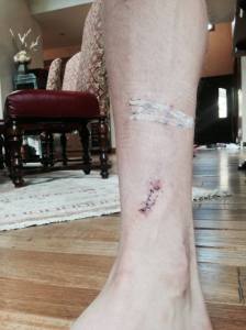 Adam Axelssons uppskurna högerben. Foto: Adam Axelsson